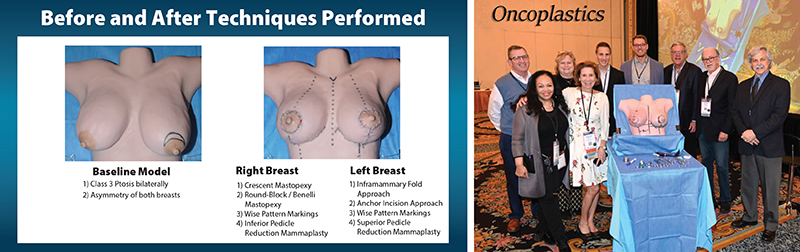 Oncoplastic Reduction: Plastic Surgeon and Breast Surgeon Working